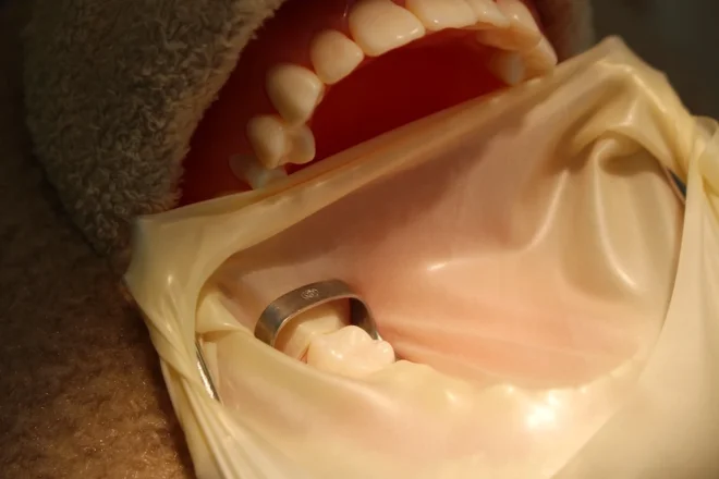 ラバーダムを使用し、治療する歯だけを露出